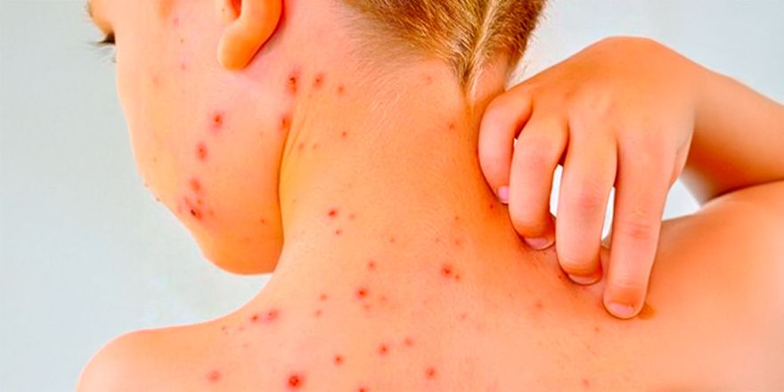 Minsal refuerza alerta por sarampión: Especialistas U. de Chile llaman a vacunarse